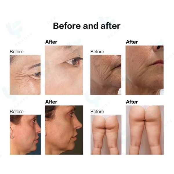 Portable 12D HIFU Beauty Machine Facial And Body And Face Lift Hifu