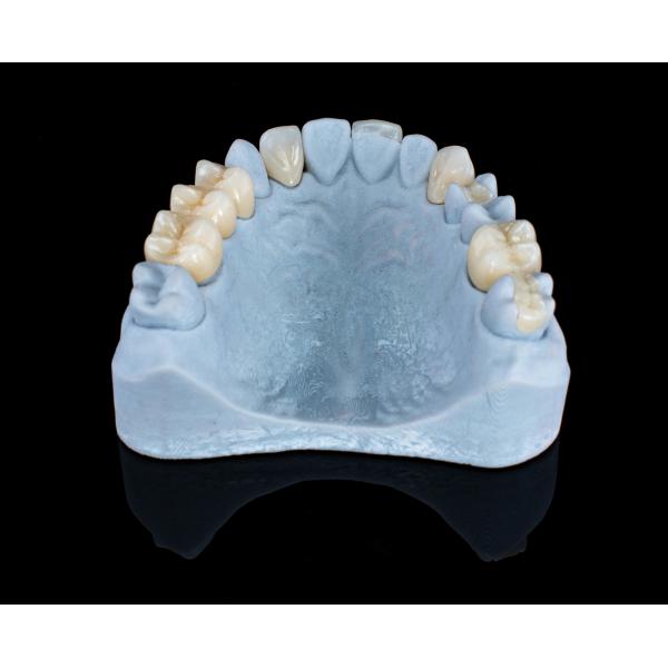 100% Custom Stain Resistant Composite Veneer Inlay Onlay For Chairside Placement