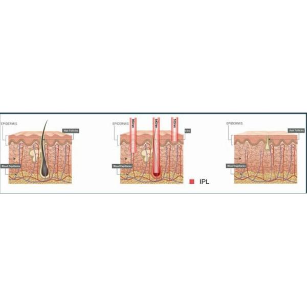 Розовое удаление волос IPL подвергает ветер механической обработке охлаждая интенсивный пульсированный свет