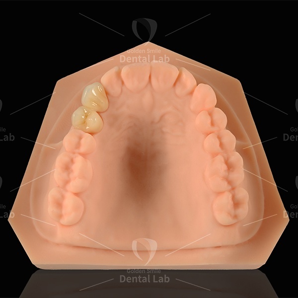 E Max Bridge Emax Laminate Veneers Lithium Disilicate Glass Ceramic Material