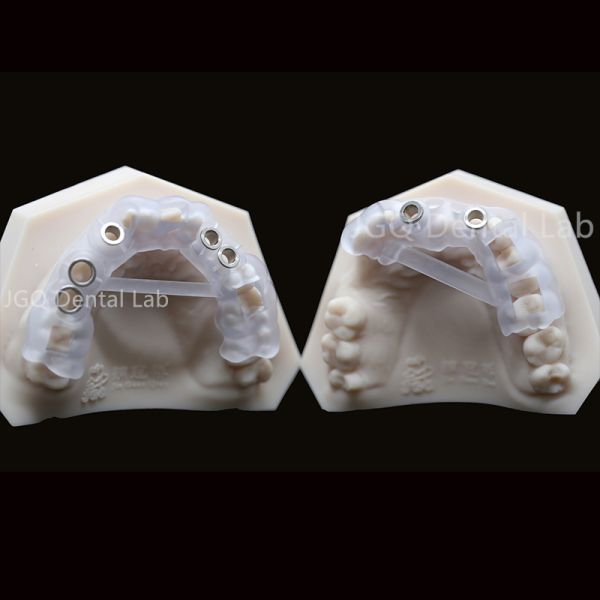 Dental Lab Customized Surgical Guide For Dental Implants 3D Laser Printing