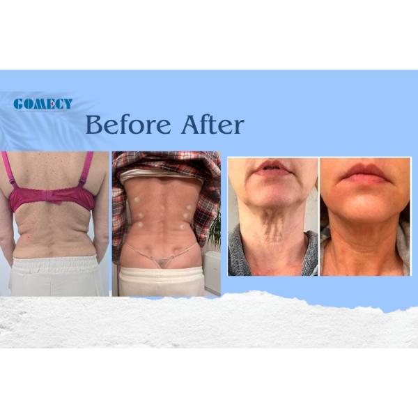 Máquina Endoláser Avanzada 980/1470nm para Lifting Facial y Tratamientos Vasculares