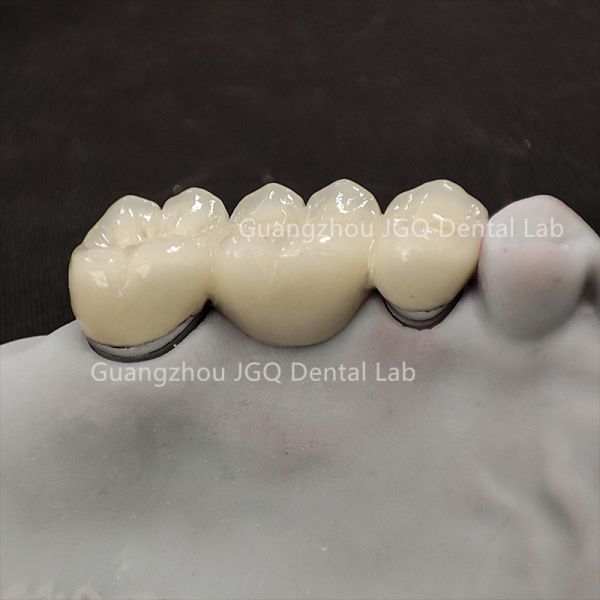 Custom China Dental Laboratory Zirconia Crown Bridge for Global Clinics