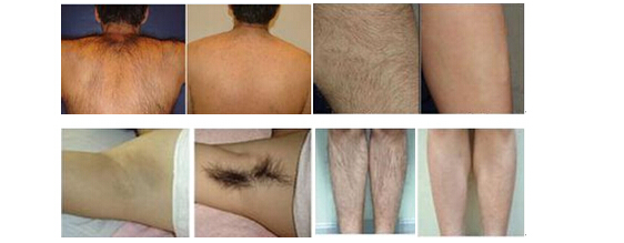 Multifunctional White Professional Ipl Hair Removal Machine Effective Weight Loss