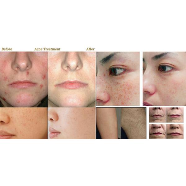 YAG IPL Laser Machine