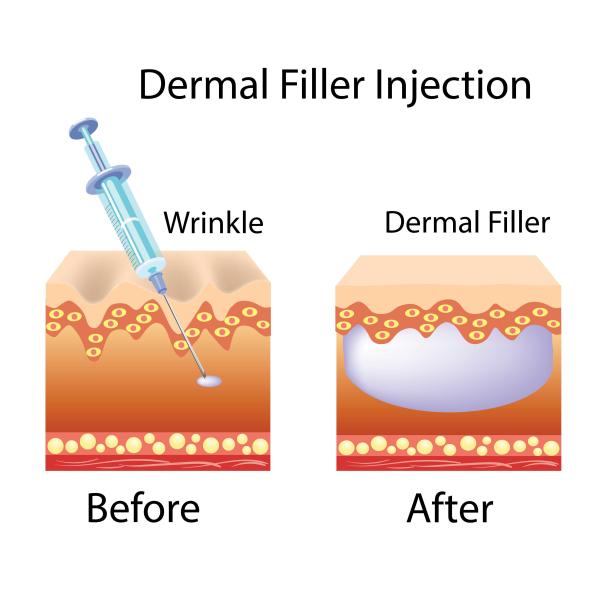 Dermal Lip Fillers JUR KISS Red Lips Injection Filler Customization Hyaluronic Acid Lip Augmentation