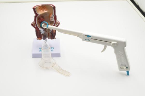 No Postoperative Bleeding Hemorrhoid Staple Surgery , No Complications Pph Stapled Hemorrhoidectomy