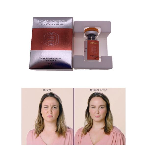 Тип токсина лицевой впрыски Botulinum срок годности при хранении 3 лет