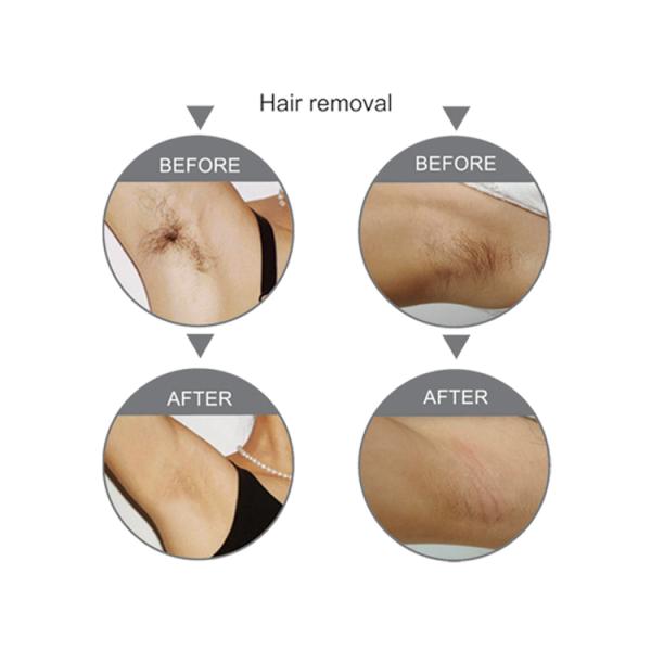 Portable Beauty Equipment Salon Use SHR Hair Removal With SPT / FCA Technology