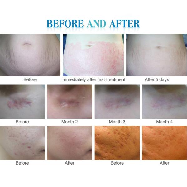 Customized Derma Pen A1 A6 A6S A7 X5 M5 M7 E30 MYM N2-C H2 for Customer Requirements