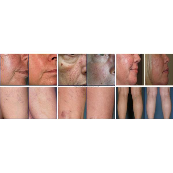 Spider Vein Vascular Removal Machine Diode Laser Remover Nails Fungus Physiotherapy