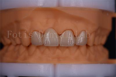 FDA Certified Digital Crowns Bridge Dentrues Design  Customizable Size