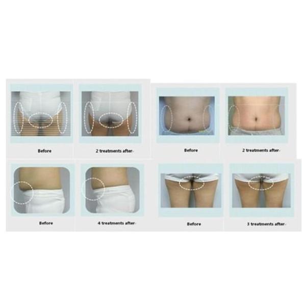 2015 New 6 in 1 dermabrasion mesotherapy peeling skin lifting cold hammer skin scrubber