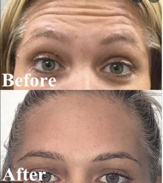 Os enrugamentos Botulinum coreanos das unidades da toxina 100 de Botulax Botox removem