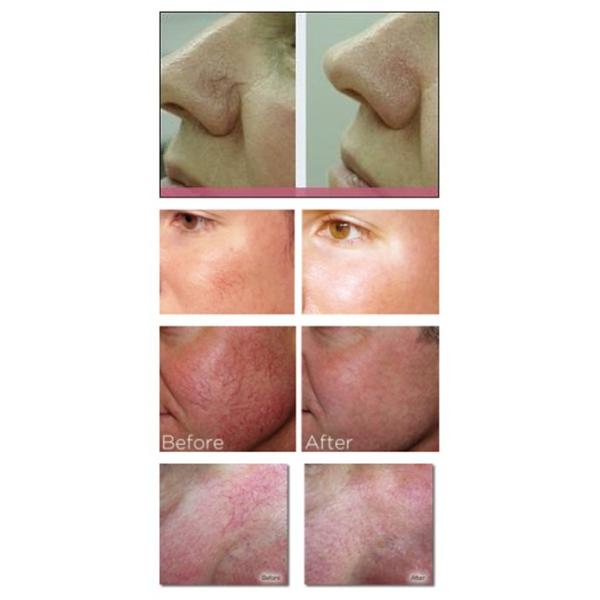 Salon use spider vein removal machine for blood Vessel Removal on face, leg