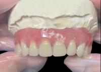 Implante de titânio apoiado em barra de fixação Dentes dentários de laboratório dentário da China