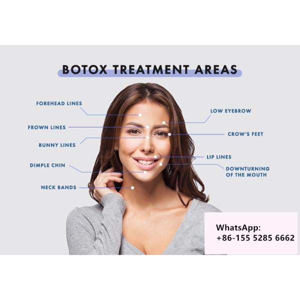 100Units Allergan Botulinum Toxion для извлекают лицевой тип a Botox морщинок