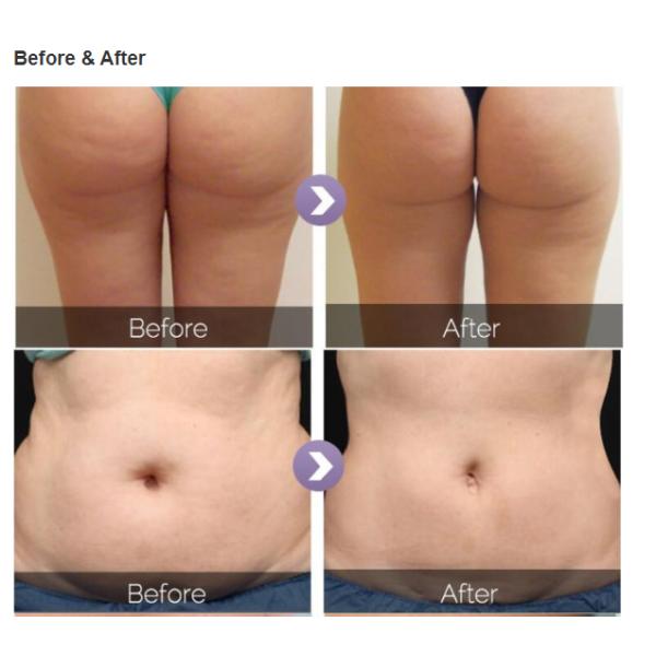 Popular Velasmooth V9 Slimming System Fat Loss Body Shaping RF Vacuum Roller Cavitation Cellulite Removal Beauty Machine