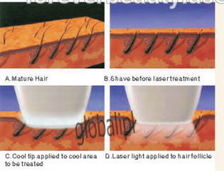 Permanent Diode Laser Hair Removal Machine For Skin Rejuvenation