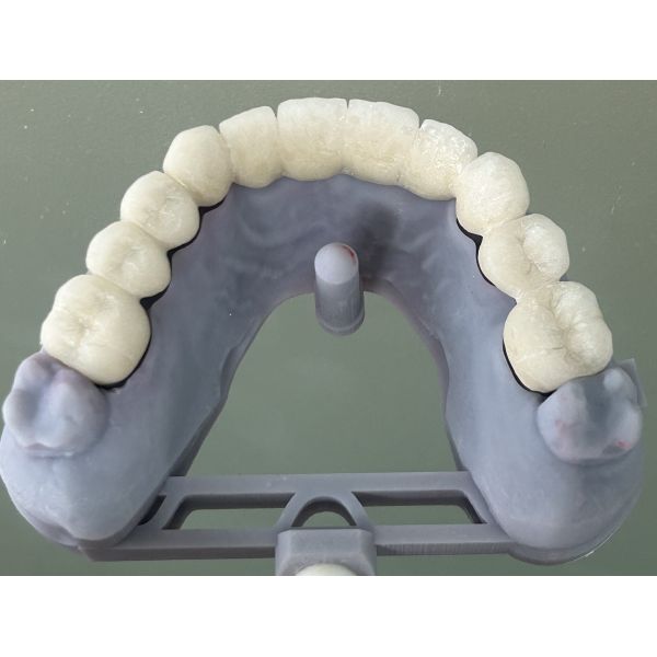 Semi-precious Porcelain Fused to Metal Dental Bridge for Durable Dental Restoration