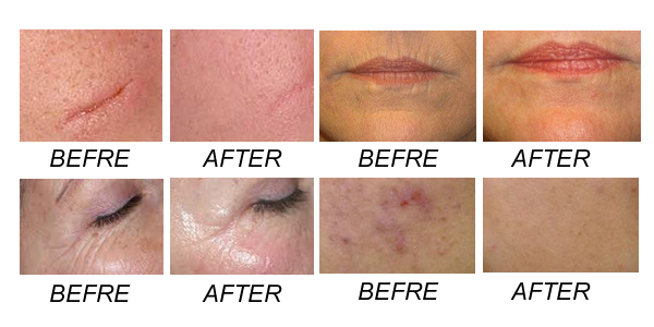 Portable Laser Tattoo Removal Machine for skin pigment removal 532nm / 1064nm