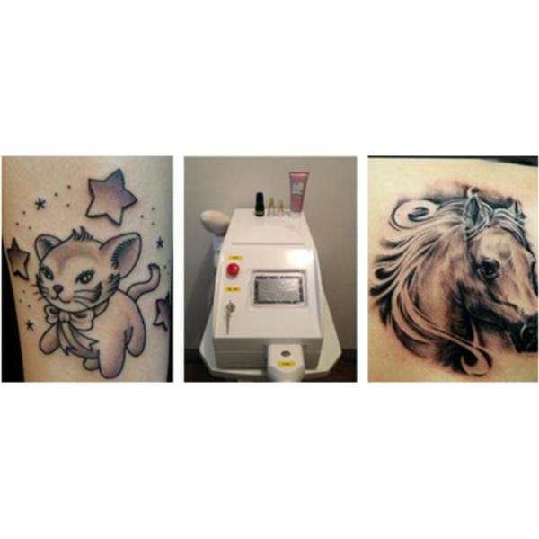 Mini Q Switch Nd Yag Laser for Removing Tattoo of All Kinds of Color CE Approved