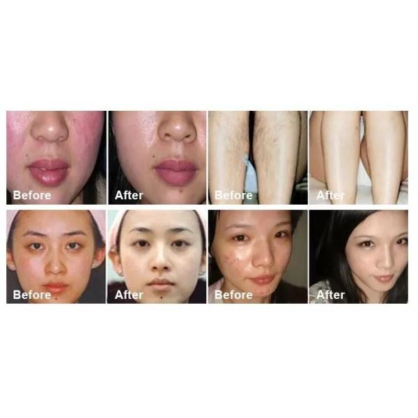 High Efficiency SHR IPL Hair Removal Machine With 360 Magneto Optical System