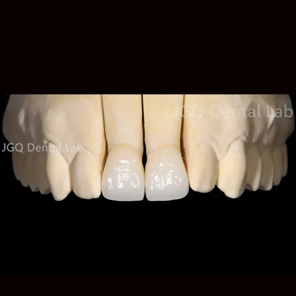 Customized Dental Crown and Bridge Porcelain Fused to Zirconia with CE FDA Certification and 3D Laser Printing
