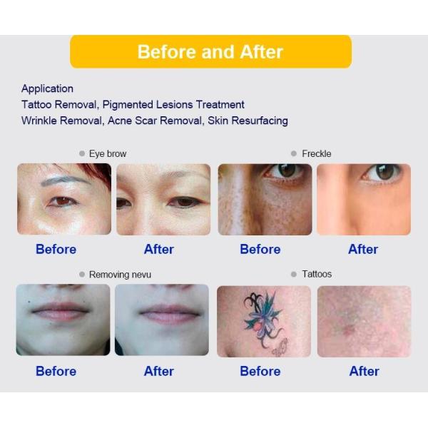 Effective Picosure Yag Laser Machine For Tattoo Removal Red / Gray Color Optional