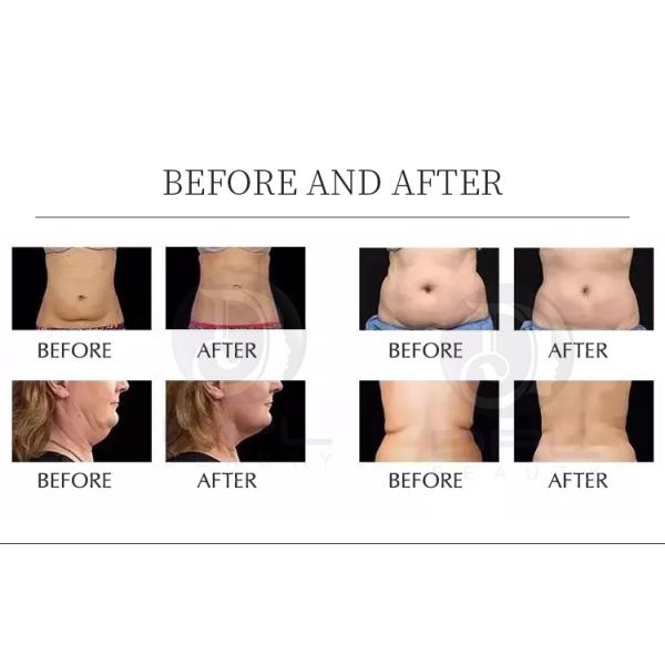 Radio Frequency S Shape 80k Ultrasonic Cavitation Vacuum Massage Bipolar Rf Fast Slimming Machine