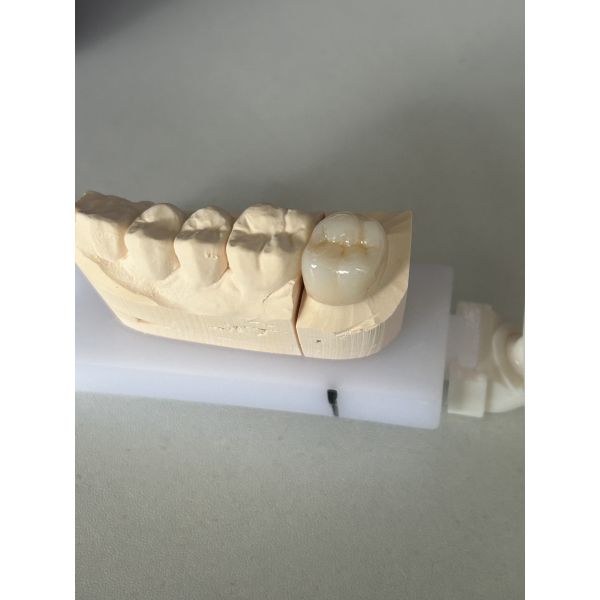 High Strength 1200 MPa Zirconia Crown with Excellent Biocompatibility and Long-lasting Durability for Dental Restoration