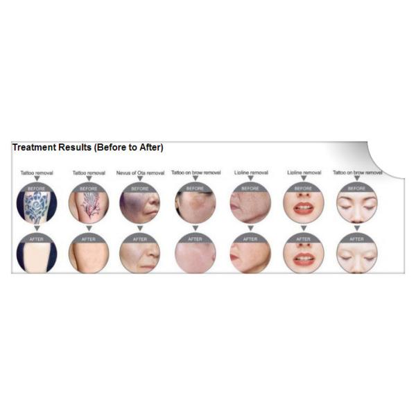 Personal Laser Tattoo Removal Machine , Yag Eyebrow Removal Machine