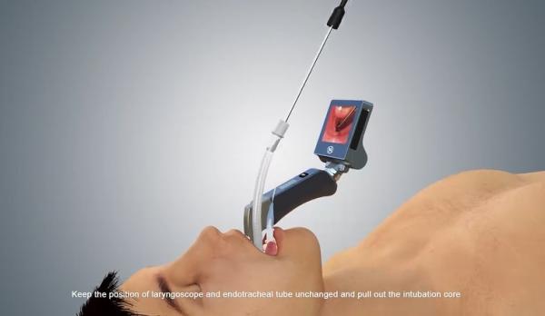 Reusable Anesthesia Video Laryngoscope Airway Intubation With Enhanced View