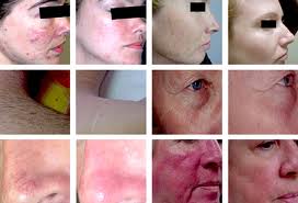 big promotion high power home ipl beauty hair beauty machines for wrinkles, acne