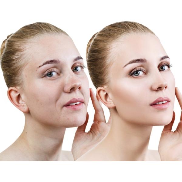 Впрыскивать тип a токсина HYAMELY Botox для того чтобы приглаживать тонкие линии на стороне