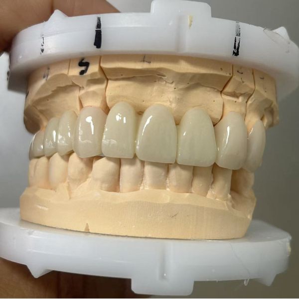 Full Zirconia dental bridge for high strength and durable dental restoration