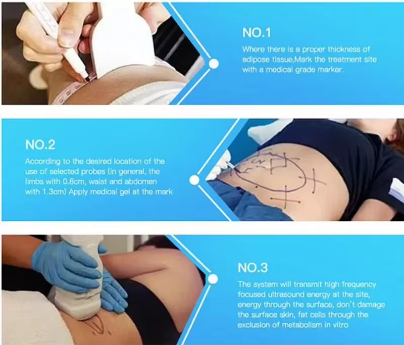 High Focused Ultrasound Hifu Liposonix Machine Liposonic For Body Slim