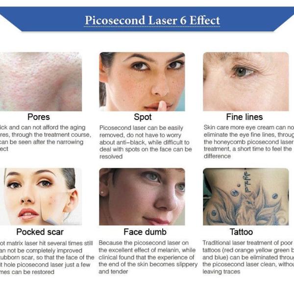 Прибор 500ps 750ps 2000ps лазера пикосекунды подтяжки лица 585nm 650nm