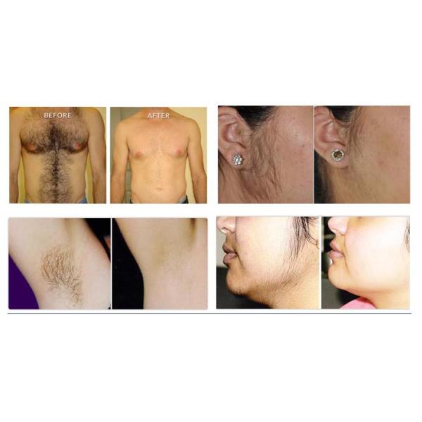 Fast Effective IPL Laser Hair Treatment Machine For Esthetic Salon Painless