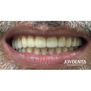 Prothèses en zirconium qui imitent les dents naturelles