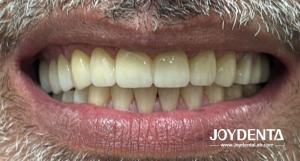 Prothèses en zirconium qui imitent les dents naturelles