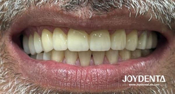 Prothèses en zirconium qui imitent les dents naturelles