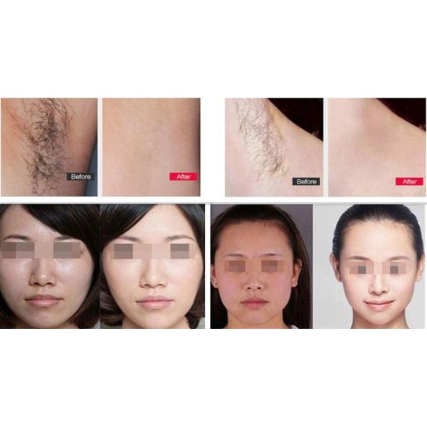 Home Use Beauty Care Distributors VPL Hair Removal Machine with 2 Handles