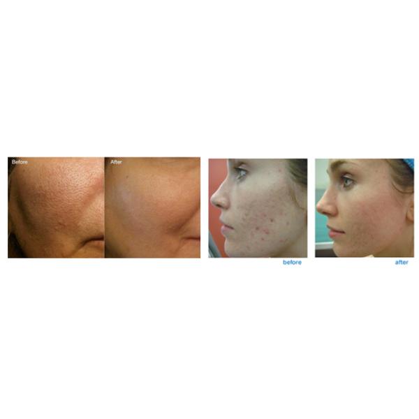 40W Fractional Co2 Laser Equipment With Metal Tube Laser Clinic Use