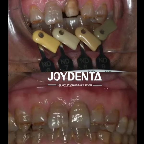 Translucency Zirconia Crowns Multilayered Gradient Technology