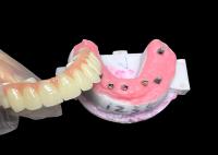 Implante suportado Prótese de arco completo Implante dentário fixo Ponte de coroa cerâmica