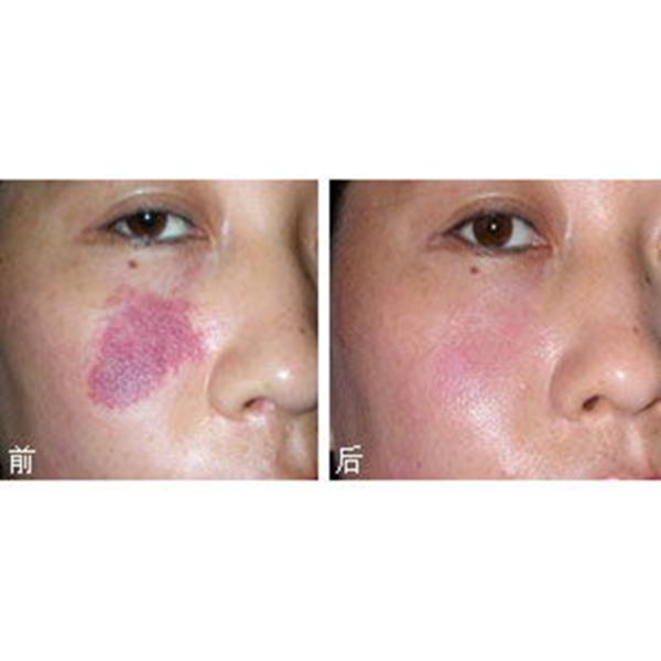 Female Beauty Salon Portable Q Switched Yag Laser For Hyper pigmentation