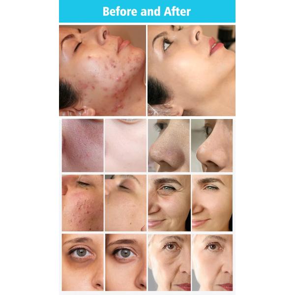 Non Invasive 9 In1 Skin Care Blackhead Removal Skin Regeneration Hydra Beauty Machine