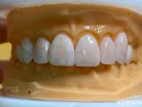 Lightweight and Smooth Dental Veneers Stain Resistance Long-lasting Durability for Optimal Comfort