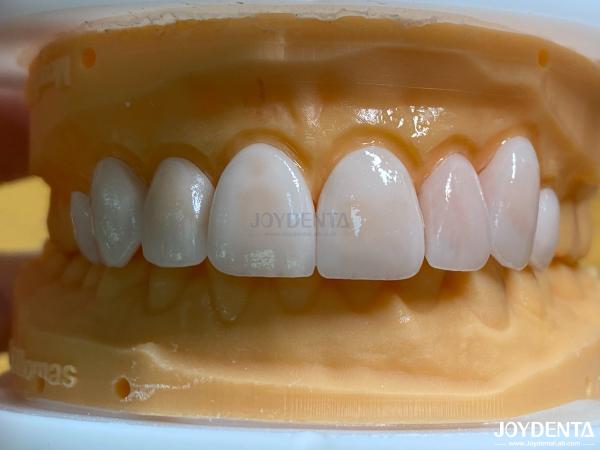 Lightweight and Smooth Dental Veneers Stain Resistance Long-lasting Durability for Optimal Comfort